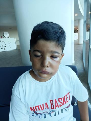 “Enfeksiyonlu Dişi Çekilen 8 Yaşındaki Çocuk: Yüzü Şişti, Gözleri Kapandı”